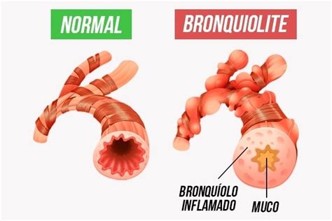 sintomas de bronquiolite - preço de fogão